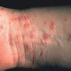 Hudutslag på handleden, troligen orsakade av kvalster bett. Röda, upphöjda prickar syns tydligt.