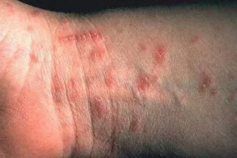 Hudutslag på handleden, troligen orsakade av kvalster bett. Röda, upphöjda prickar syns tydligt.