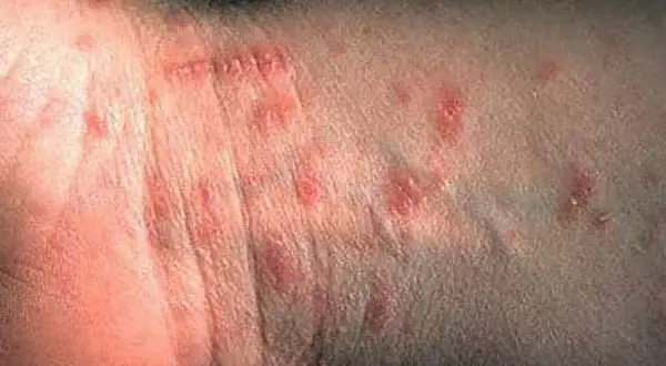 Hudutslag på handleden, troligen orsakade av kvalster bett. Röda, upphöjda prickar syns tydligt.