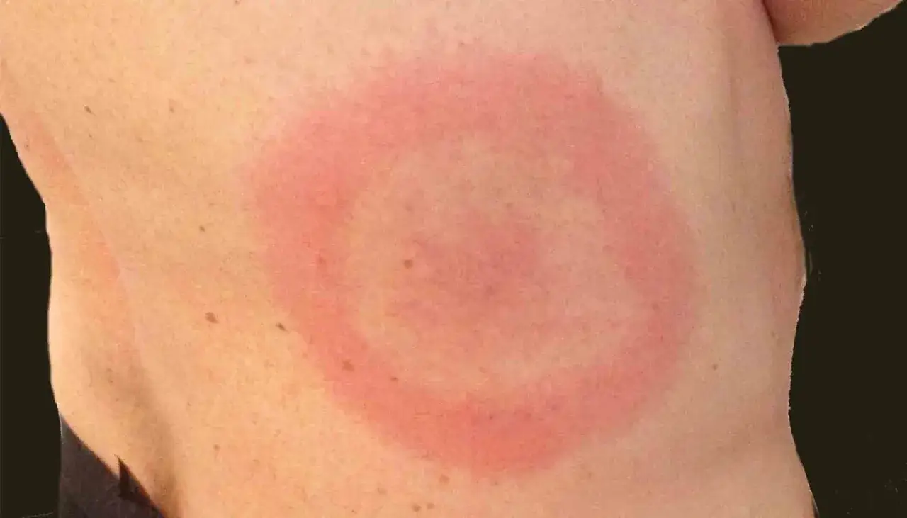 Hudrodnad med en r&ouml;d ring, liknande ett kvalsterbett.