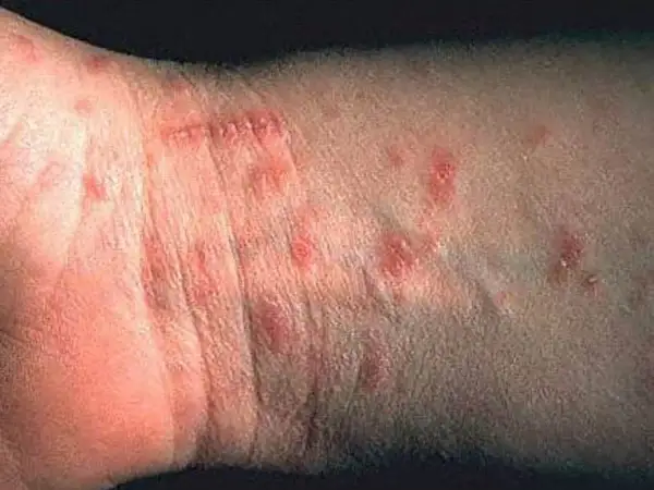 Hudutslag på handleden, troligen orsakade av kvalster bett. Röda, upphöjda prickar syns tydligt.